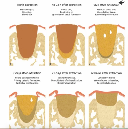 Процесс удаления зуба фото Alveolar Ridge Preservation and Immediate Implant Placement (Biologic and Surgic