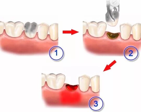 Процесс удаления зуба фото Лечение альвеолита в зубной клинике у метро Просвещения и Дквяткино
