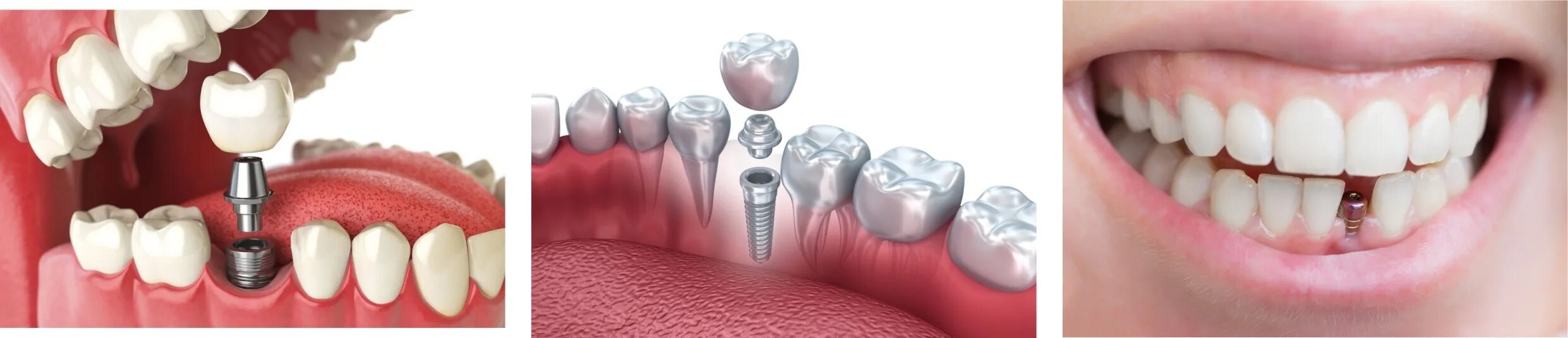 Процесс установки импланта пошагово с фото Имплантация верхних и нижних зубов: особенности и сроки