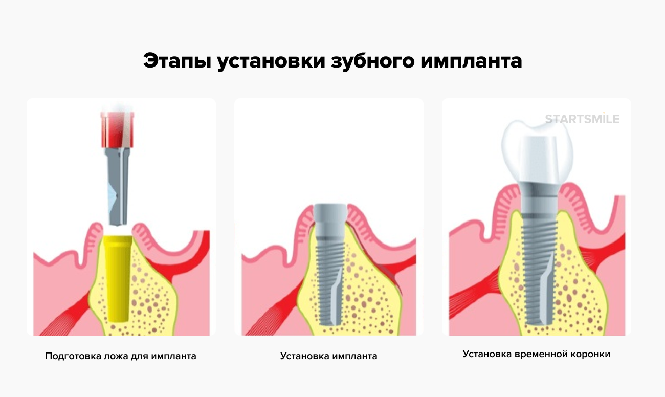 Процесс установки импланта пошагово с фото Имплантация зубов - этапы, виды, фото, как делают операцию по установке зубного 