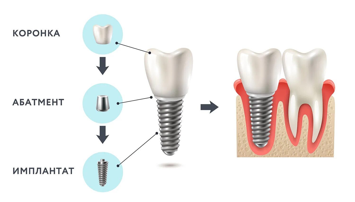 Процесс установки импланта пошагово с фото Имплантация зубов: что нужно знать - ООО "Центр Стоматологии 32 Практика"