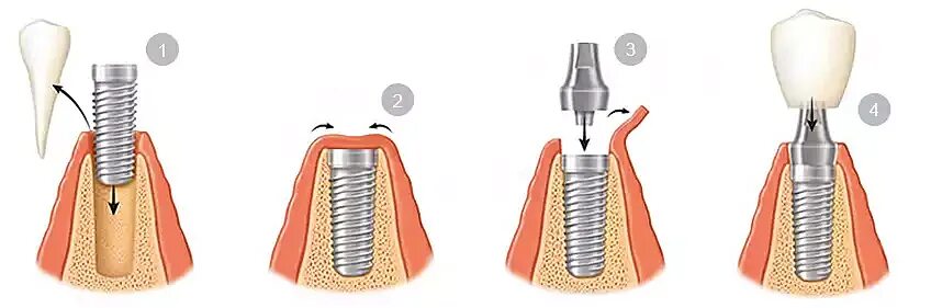 Процесс установки импланта пошагово с фото Вставить зубы имплантанты: этапы установки имплантов зубов, цена в Москве