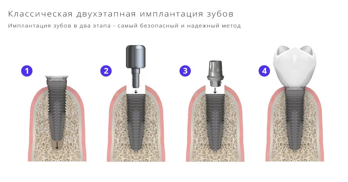 Процесс установки импланта зуба поэтапно фото Двухэтапная имплантация зубов классическая имплантация, цена