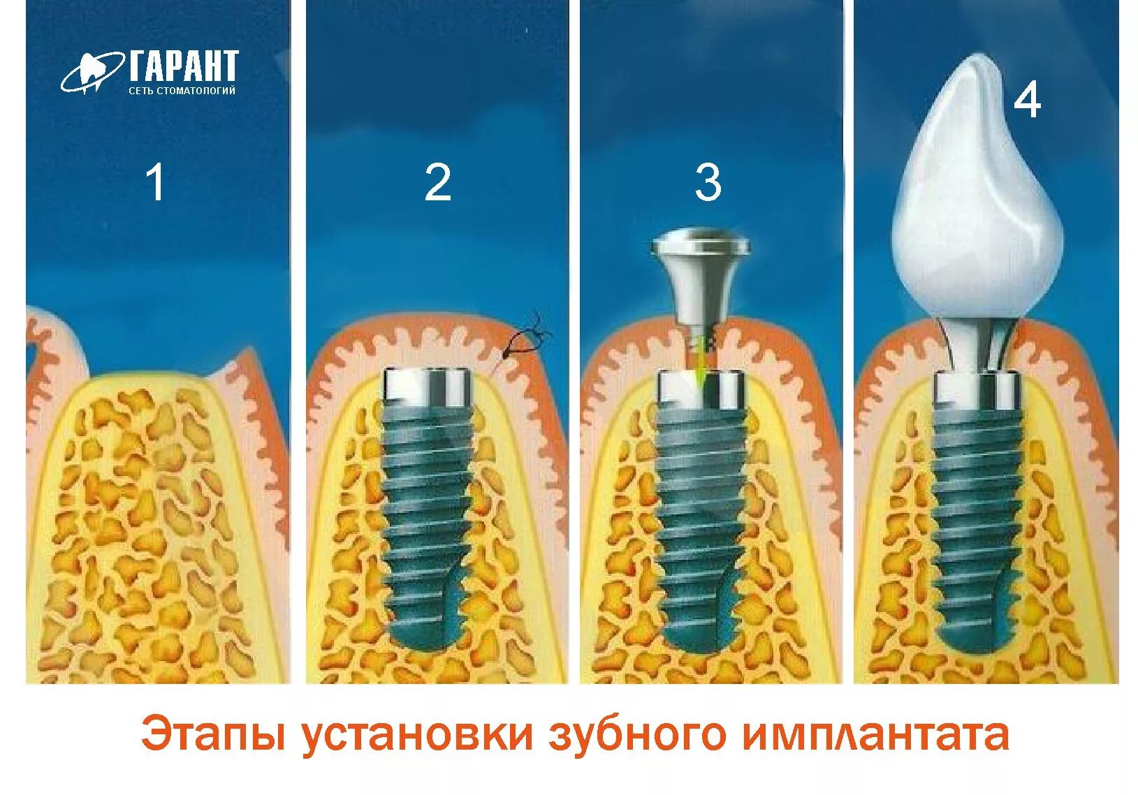 Процесс установки импланта зуба поэтапно фото Порядок установки имплантов - найдено 87 картинок