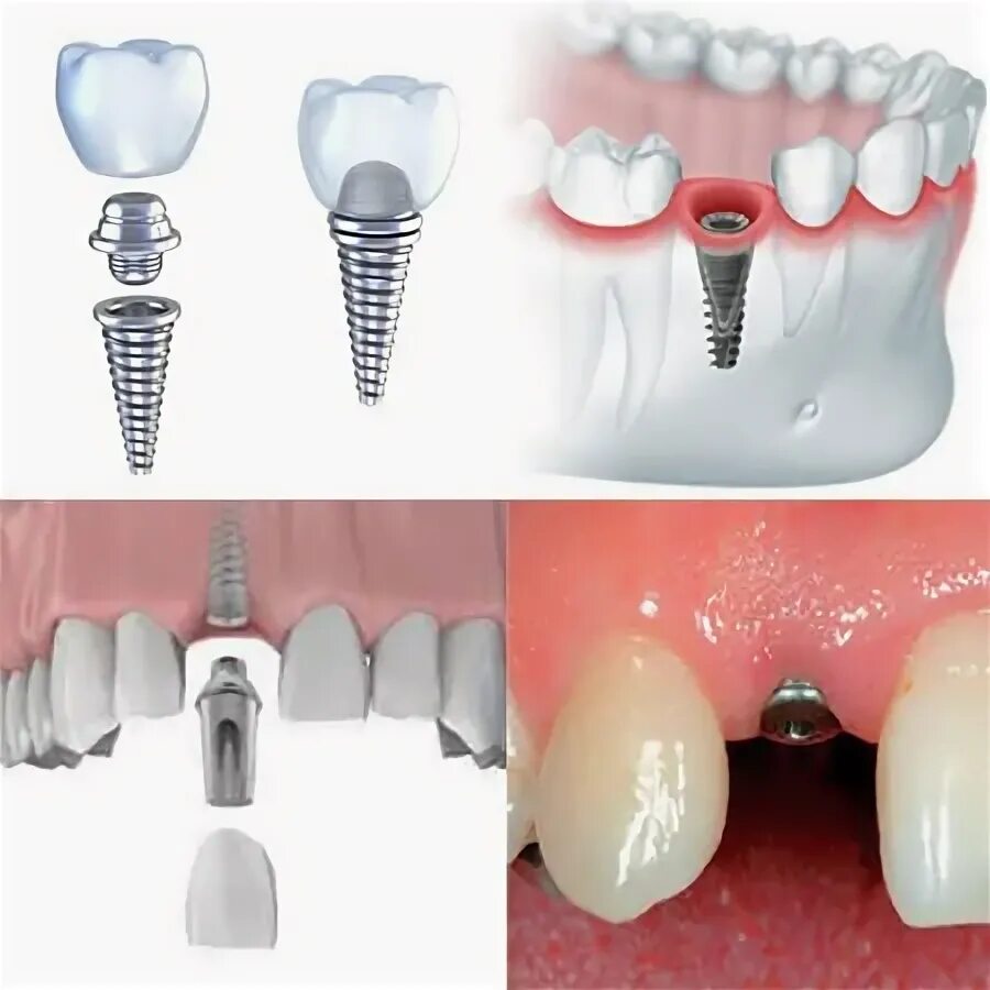 Процесс установки импланта зуба поэтапно фото пошагово Одномоментная имплантация зубов в СПб: цены в стоматологии Axioma Dental