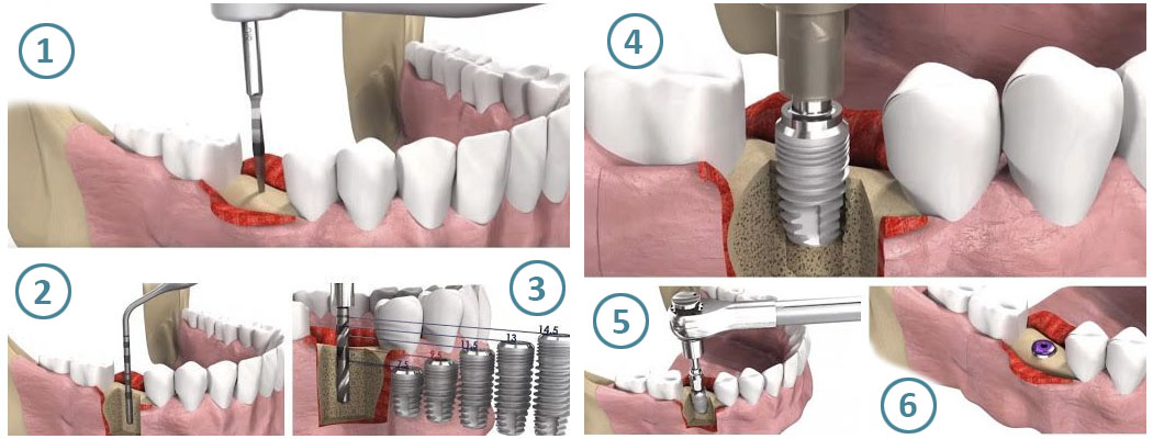 Процесс установки импланта зуба поэтапно фото пошагово Классическая имплантация зубов "под ключ" в Минске