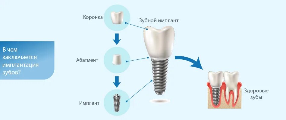 Процесс установки импланта зуба поэтапно фото пошагово Анализы для имплантации