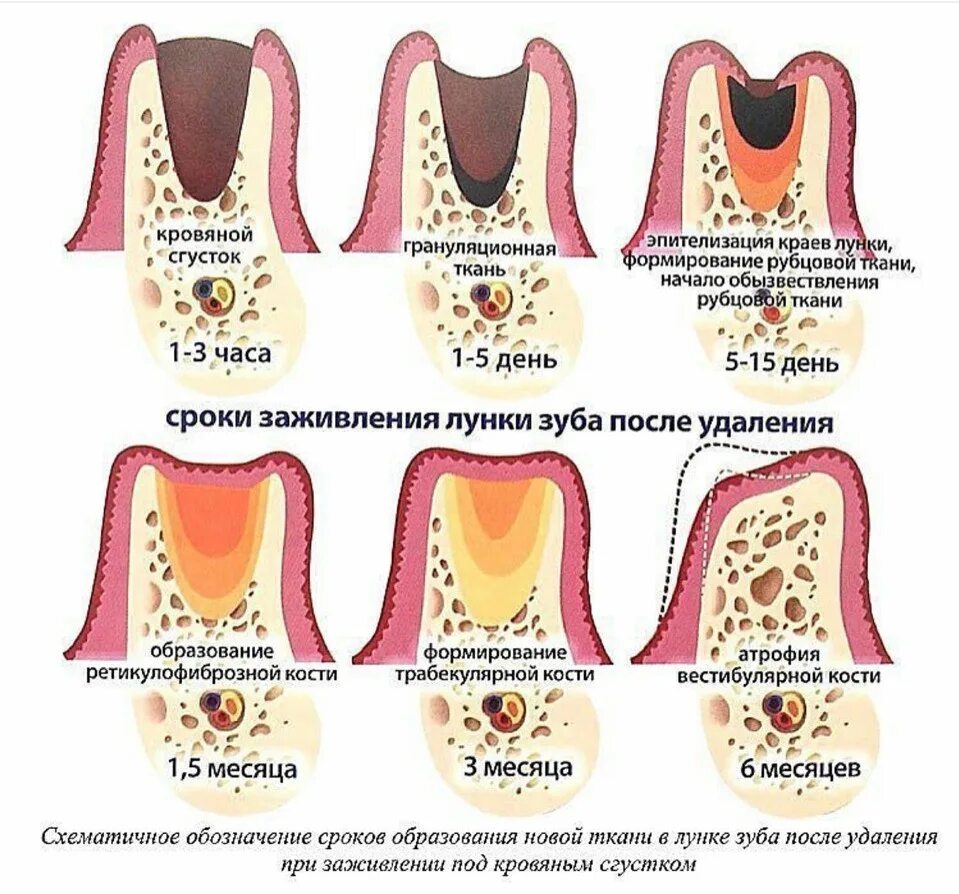 Процесс заживления лунки после удаления зуба фото Через сколько убрать вату после удаления зуба