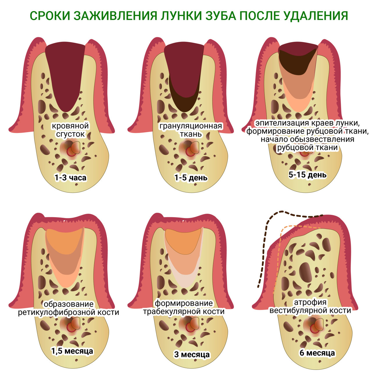 Процесс заживления лунки после удаления зуба фото Уход после удаления зуба: полоскание, антисептики