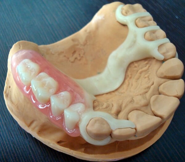 Протез квадротти на нижнюю челюсть фото Зубной ацеталовый протез - Стоматология Mr. Dent