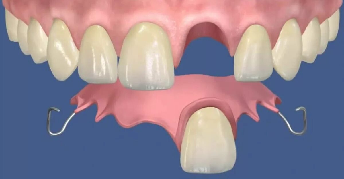 Протез на 1 зуб фото Иммедиат-протезы цена, зубной протез бабочка в Москве Стоматология Доктора Севак