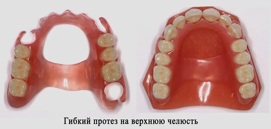 Протез на верхнюю челюсть фото цена Как самостоятельно создать зубные протезы: виды съемных моделей и рекомендации п