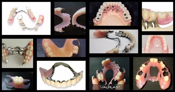 Протез своими руками в домашних условиях Вставной зуб 5 букв - найдено 90 картинок