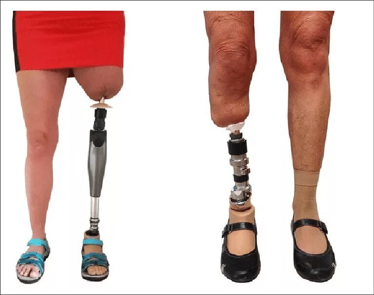 Протез выше колена фото Bone-anchored prostheses. Right: transfemoral bone-anchored prosthesis... Downlo