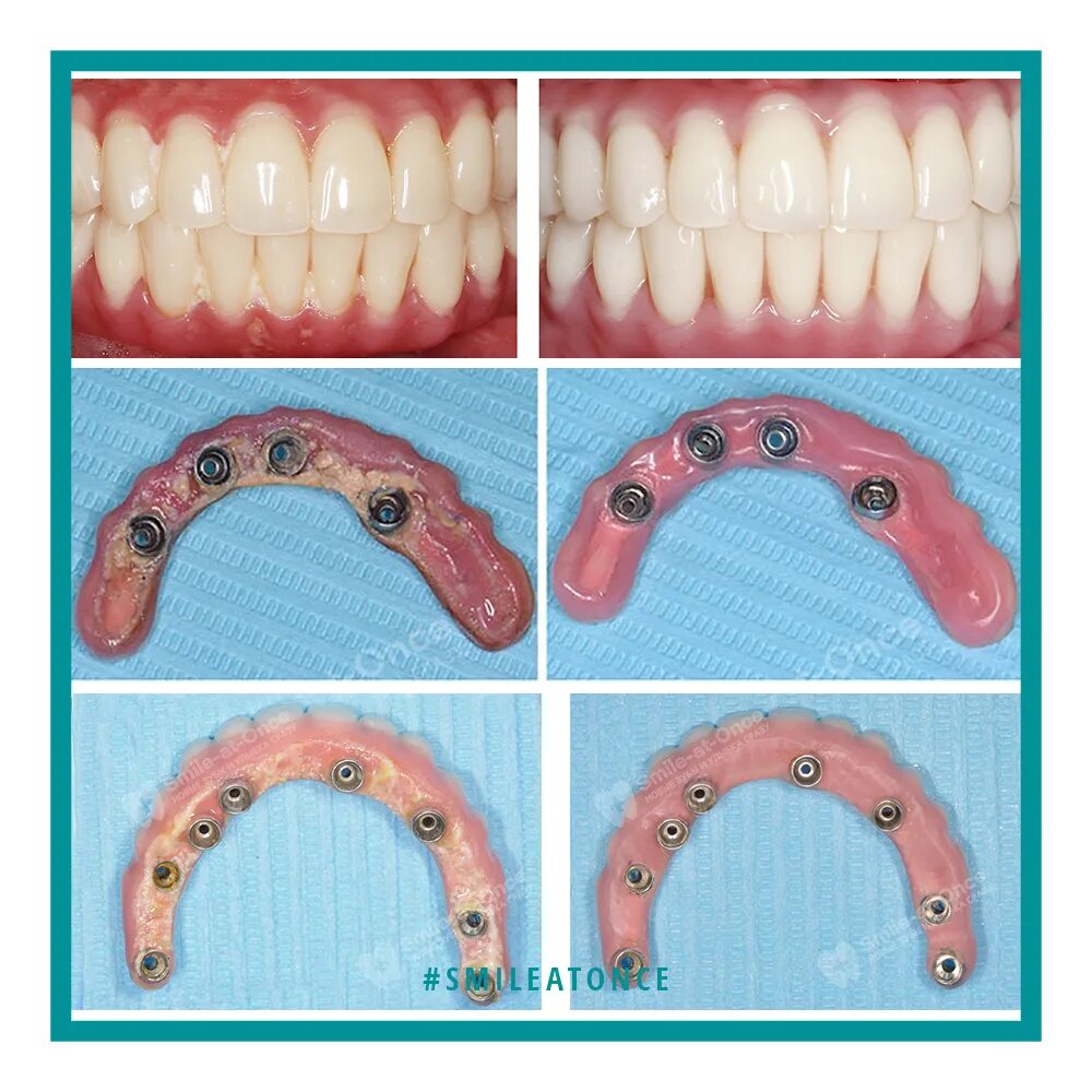 Протез зуба фото до и после Имплантация зубов до и после - Арт Минск.ру