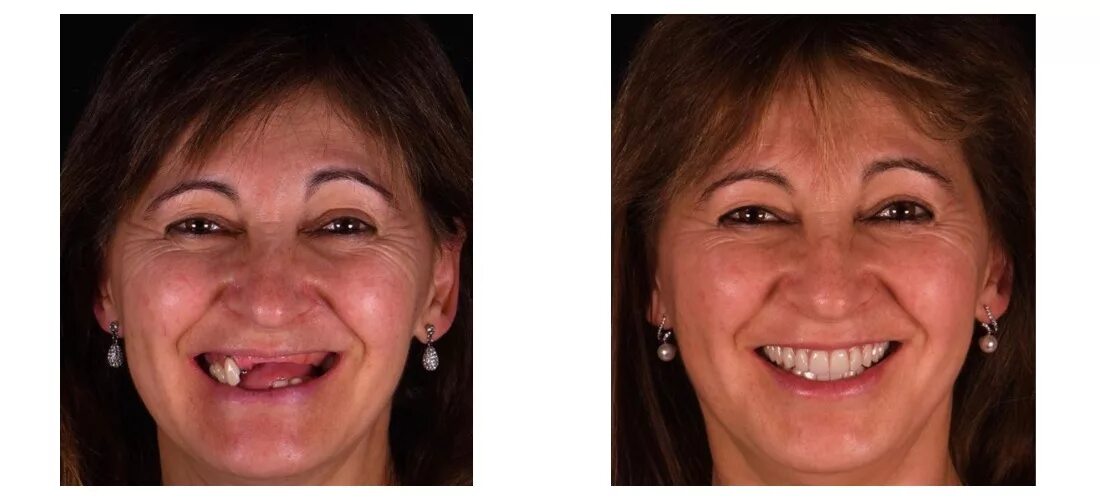 Протезирование передних верхних зубов варианты фото Установка акриловых зубных протезов в СПб - цены, бесплатная консультация