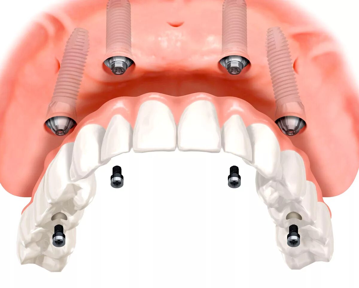 Протезирование верхней челюсти фото Имплантация зубов на верхней челюсти