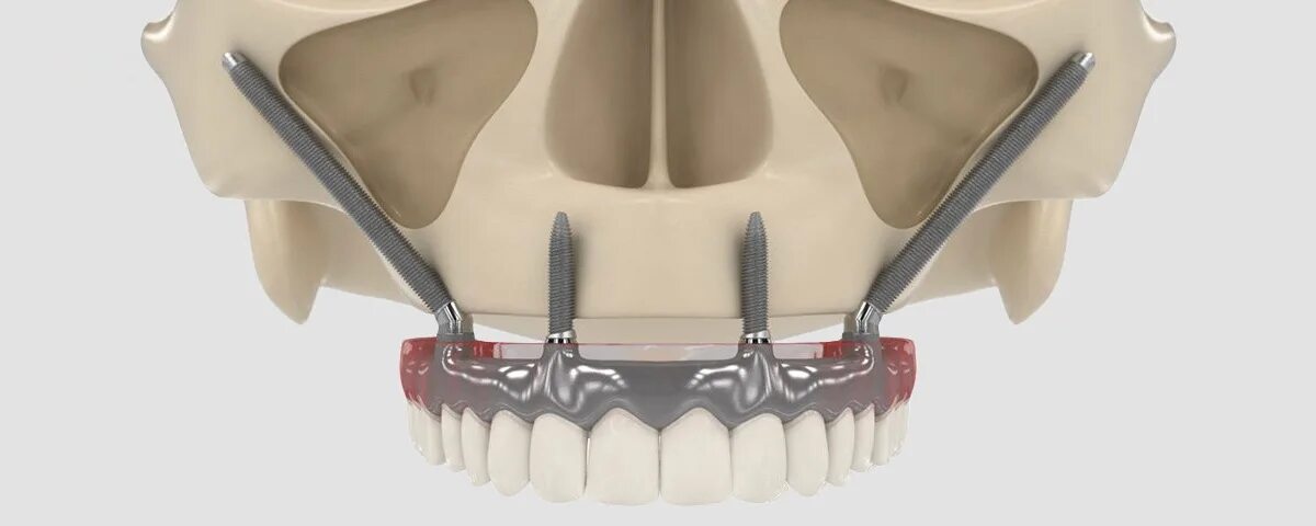 Протезирование верхней челюсти фото Имплантация верхних зубов челюсти в Москве - цены в стоматологии доктора Лемберг