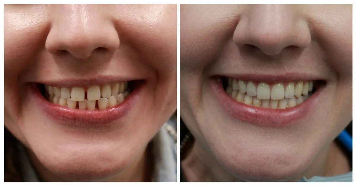 Протезирование зубов фото до и после Invisalign Cost NYC Save over $1400 with Our Invisalign Deals