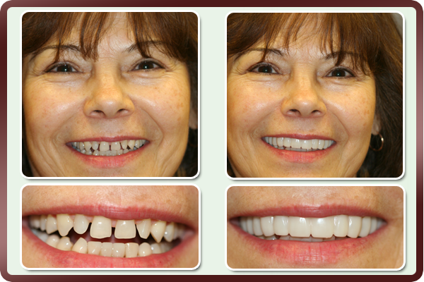 Протезирование зубов фото до и после Pin by Moo Gc on Salud dental Snap on smile, Teeth whitening procedure, Veneers 