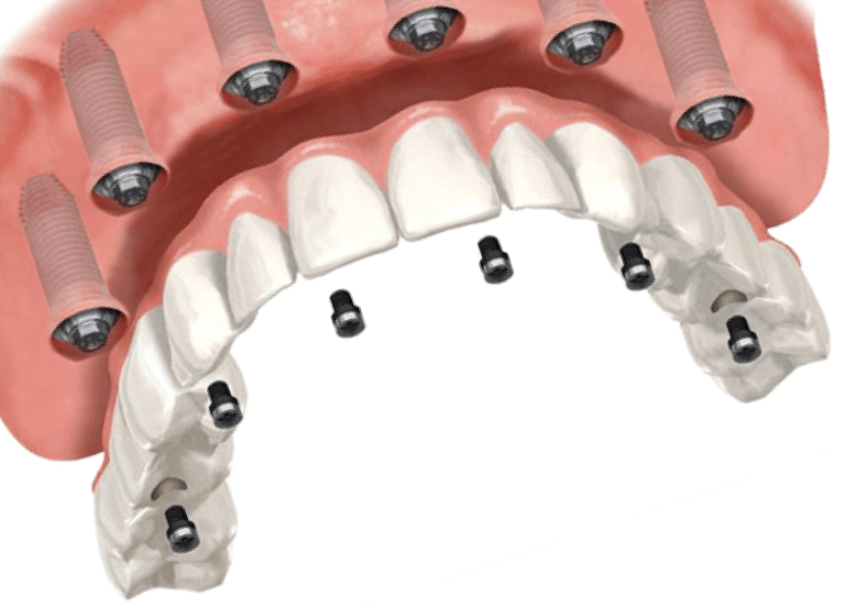 Протезирование зубов на имплантах фото Имплантация зубов All-on-6 в Москве - Цена имплантации "всё на шести"