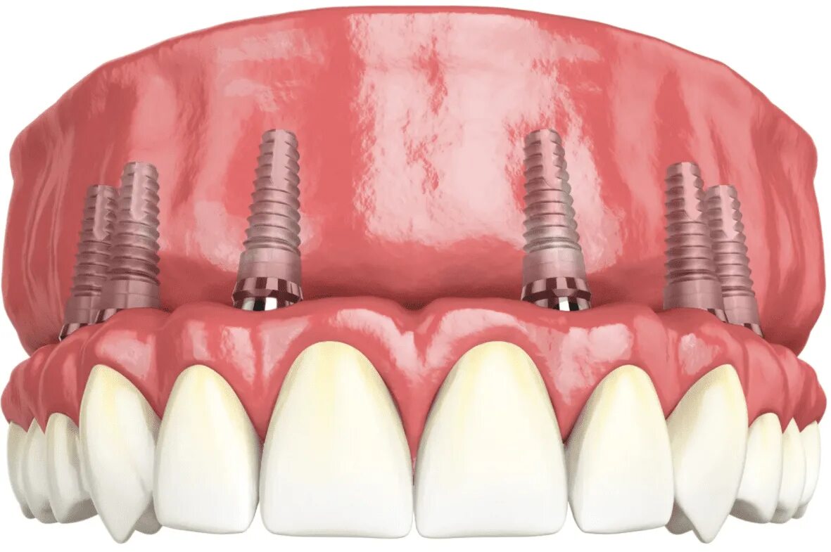 Протезирование зубов на имплантах фото Имплантация зубов верхней челюсти в Новосибирске Центр стоматологии Белой Аптеки