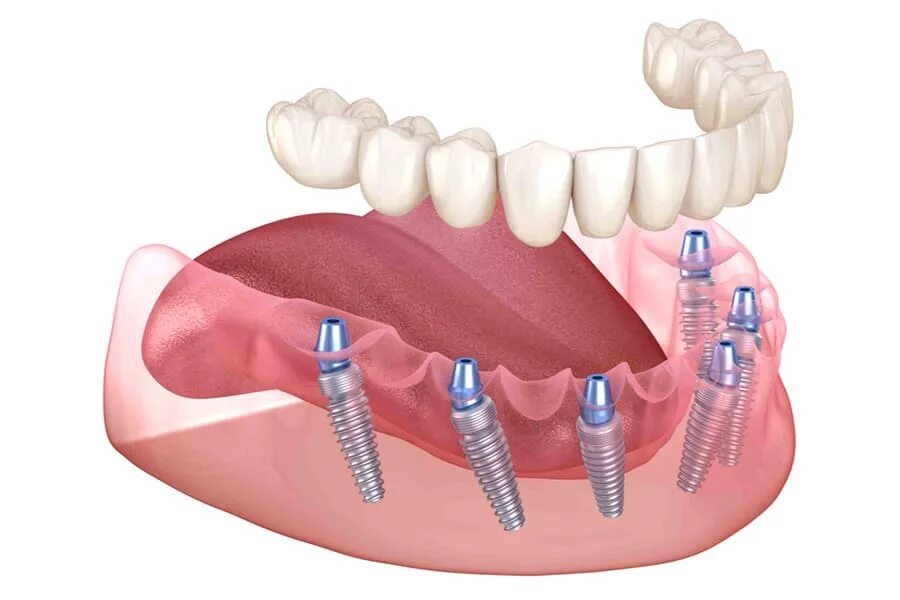 Протезирование зубов на имплантах фото Имплантация зубов All-on-6 под ключ - цена от 400000 ₽ в Санкт-Петербурге