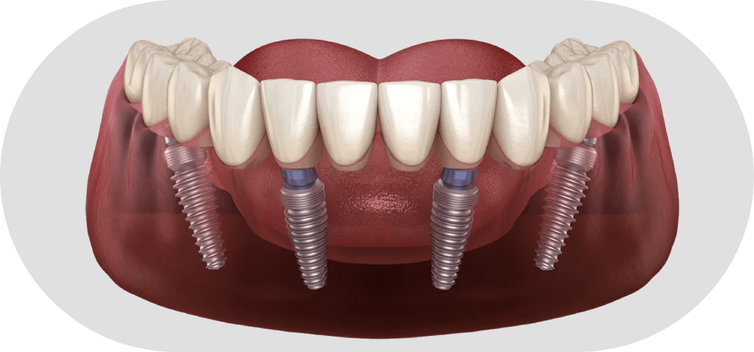 Протезирование зубов на имплантах фото Имплантация зубов ALL-ON-4 (все на 4 имплантах) в Краснодаре под ключ, в стомато