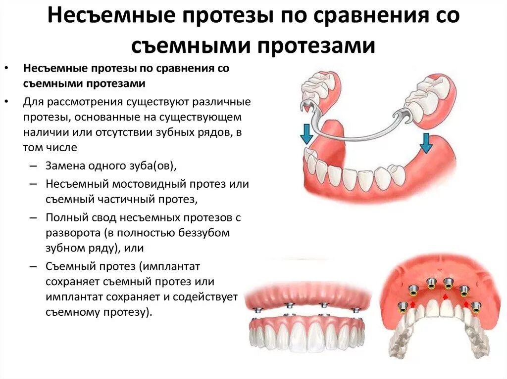 Протезирование зубов виды какой протез лучше фото Протезирование зубов - виды и цены в Москве Стоматология Максима Шубных на Можай