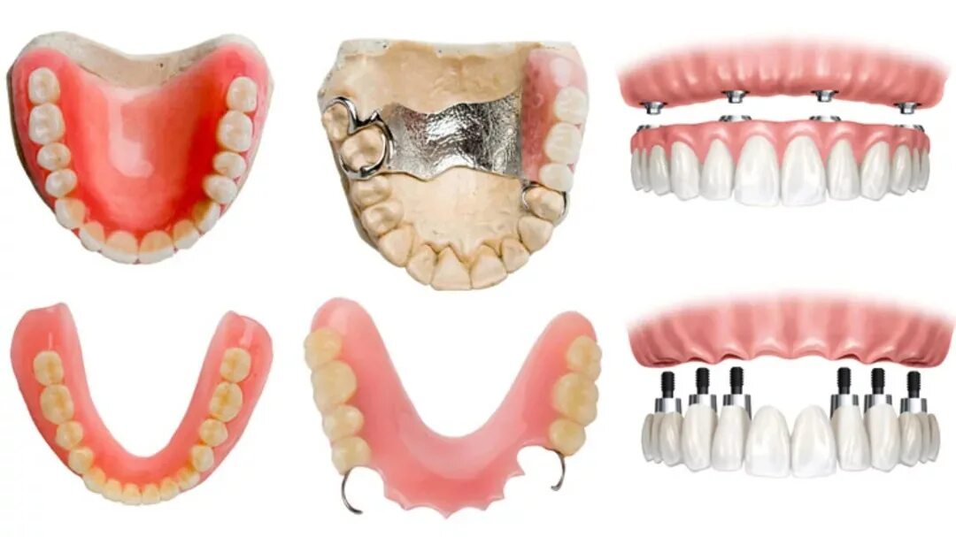 Протезирование зубов виды какой протез лучше фото Зубные протезы в Сочи - протезирование зубов недорого в стоматологии "Скаковский