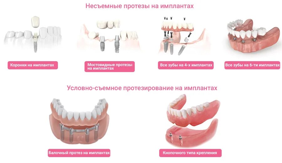 Протезирование зубов виды протезов фото Как проводится имплантация зубов и в чем разница между одиночными имплантами и с