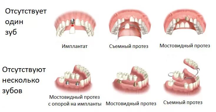 Протезирование зубов виды протезов фото Частичные протезы зубов: цена, виды, отзывы НоваДент