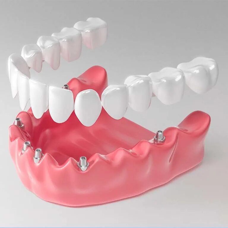 Протезирование зубов виды протезов фото цена Имплантация зубов нижней челюсти в Москве, цены и особенности имплантации передн