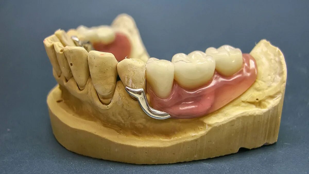 Протезы бюгельные для зубов как выглядят Изготовление бюгельных зубных протезов