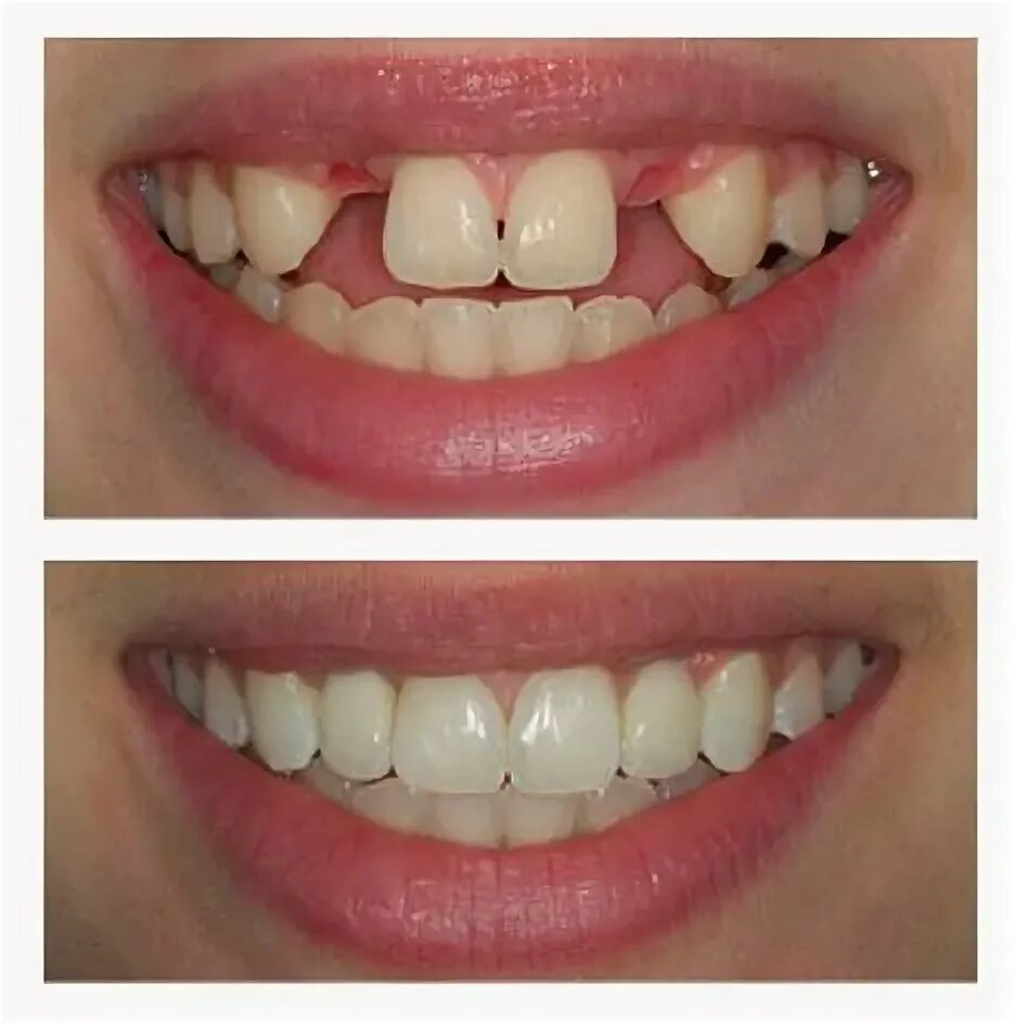 Протезы на передние верхние зубы фото before and after connective tissue grafts and maryland bridges. Teeth implants, 