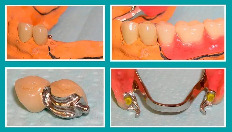 Протезы на замках фото Бюгельные протезы на замках: комфортное протезирование, новейшие технологии