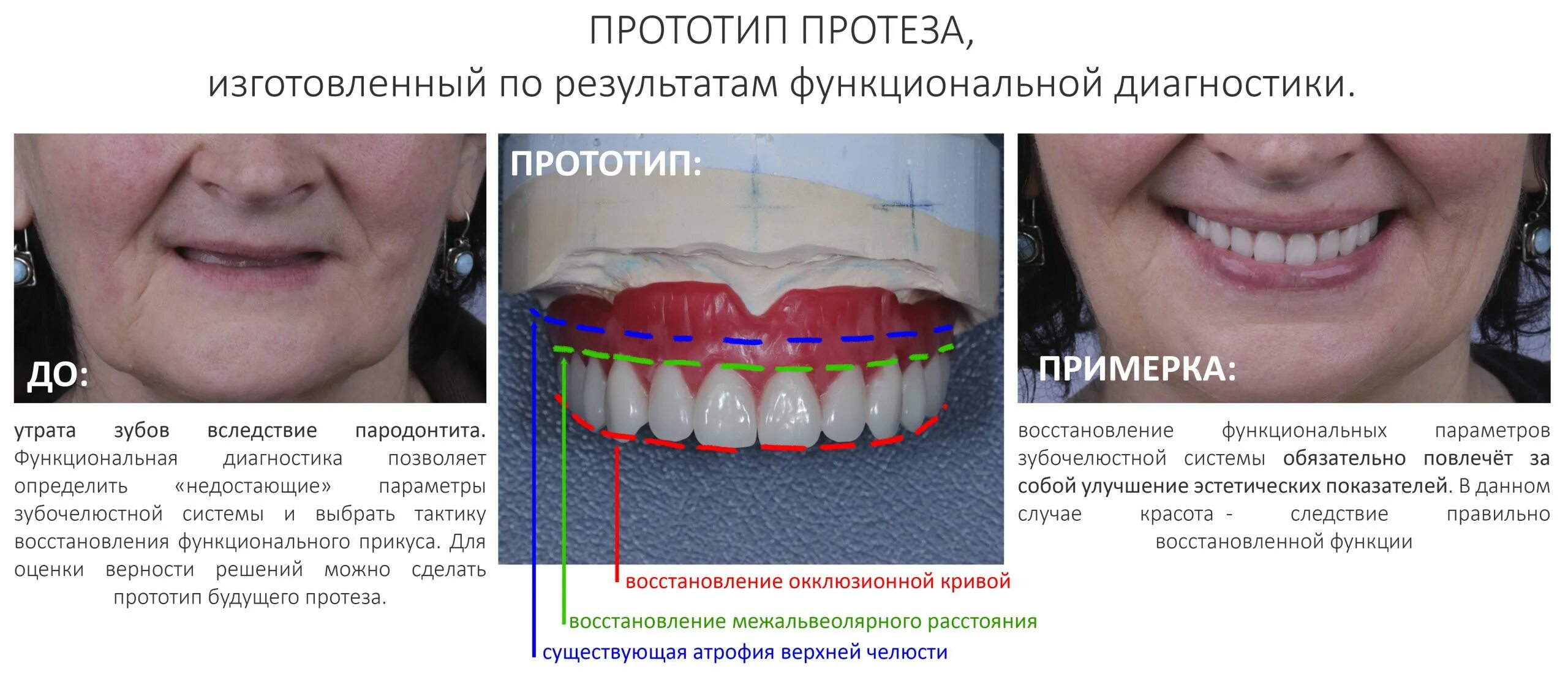 Протезы при полном отсутствии зубов фото На четырёх","на шести", съёмное и несъёмное - имплантация и протезирование при п