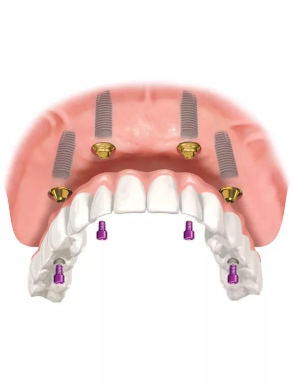 Протезы при полном отсутствии зубов фото Протезирование на имплантах зубов при полном отсутствии, цена