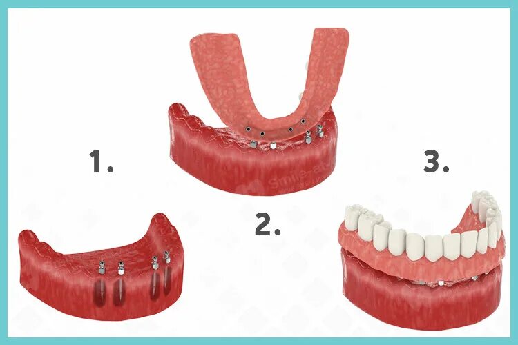 Протезы при полном отсутствии зубов фото Мини-импланты: можно ли восстановить все зубы? Стоматология Smile-at-Once Дзен