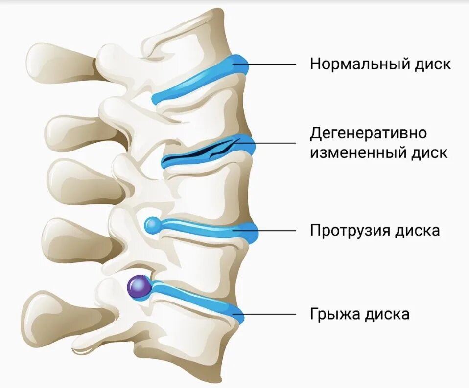 Протрузии межпозвонковых дисков фото Колоссальный опыт восстановления грыж и протрузий в позвоночнике без операций