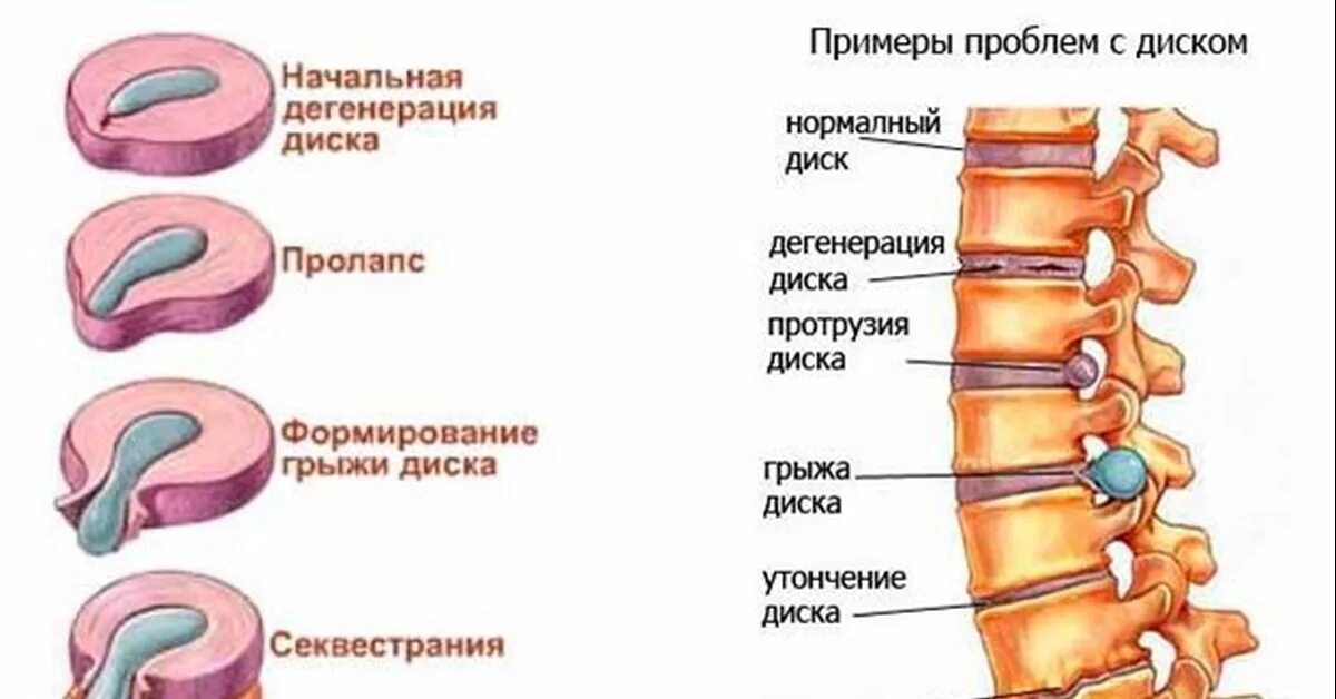 Протрузии межпозвонковых дисков фото Резорбция грыжи межпозвонкового диска. Реальный пример и теория Пикабу