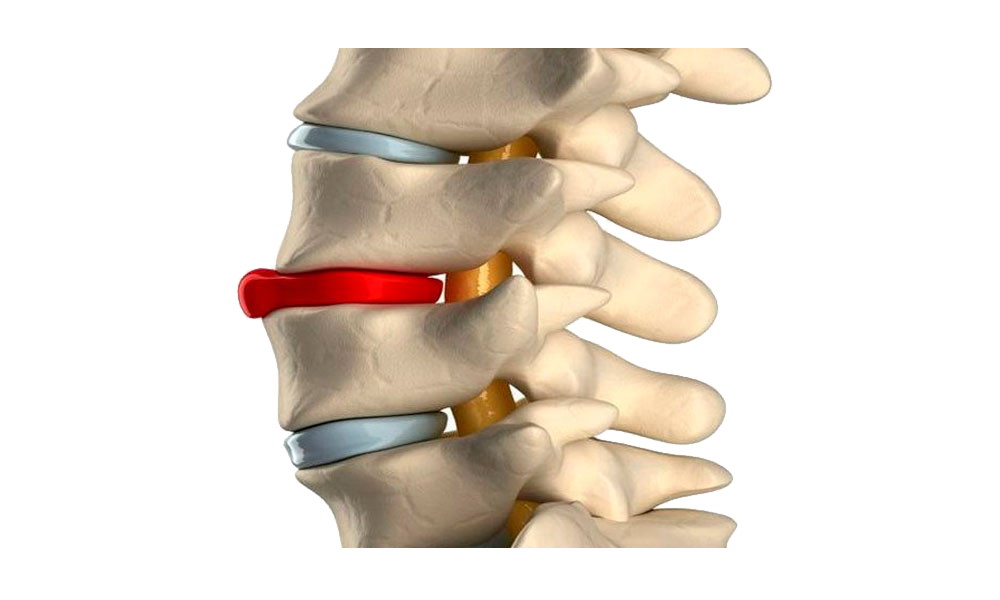 Протрузии межпозвонковых дисков фото Возможно ли лечение грыжи без операции
