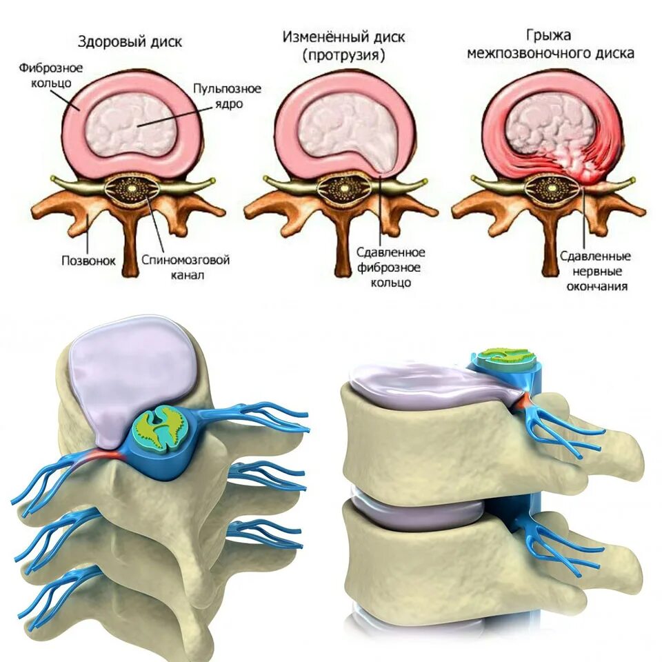 Протрузии межпозвонковых дисков фото Картинки СТЕРЛИСЬ МЕЖПОЗВОНОЧНЫЕ ДИСКИ