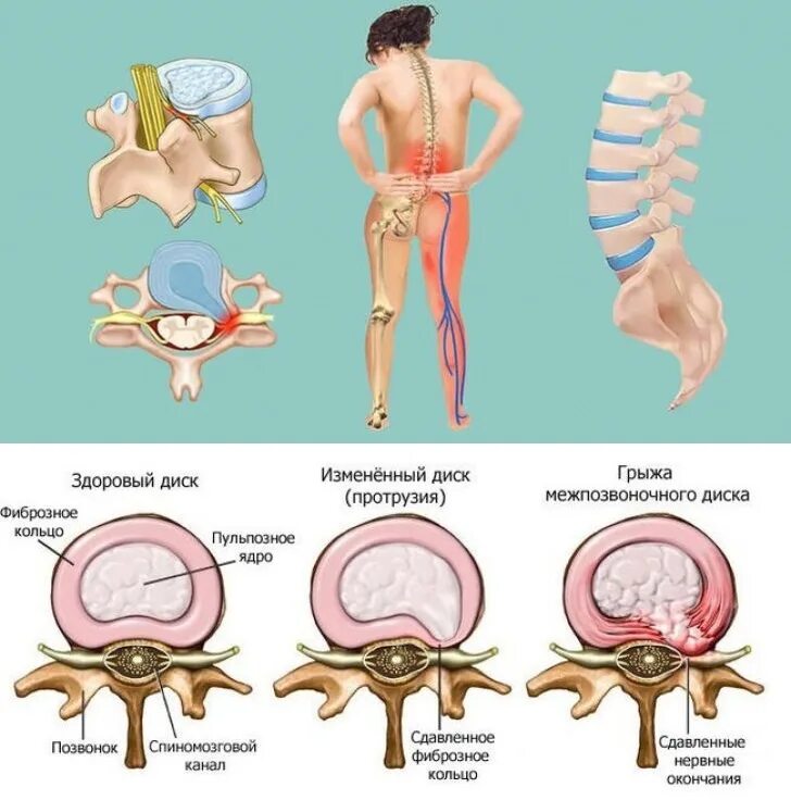 Протрузии межпозвонковых дисков фото Операция протрузия позвоночника