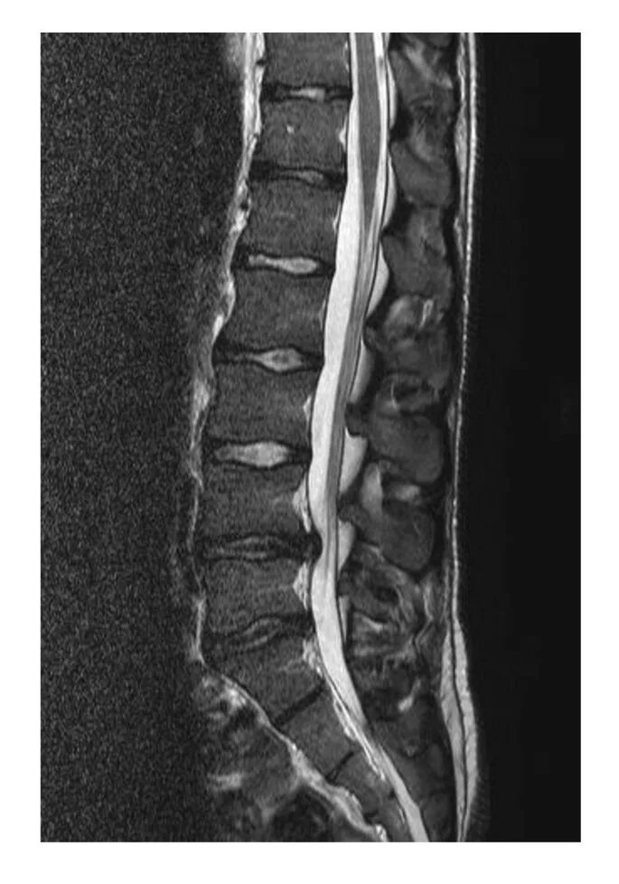 Протрузии межпозвонковых дисков фото Lumbar disc herniation in three patients with cystic fibrosis: a case series Jou