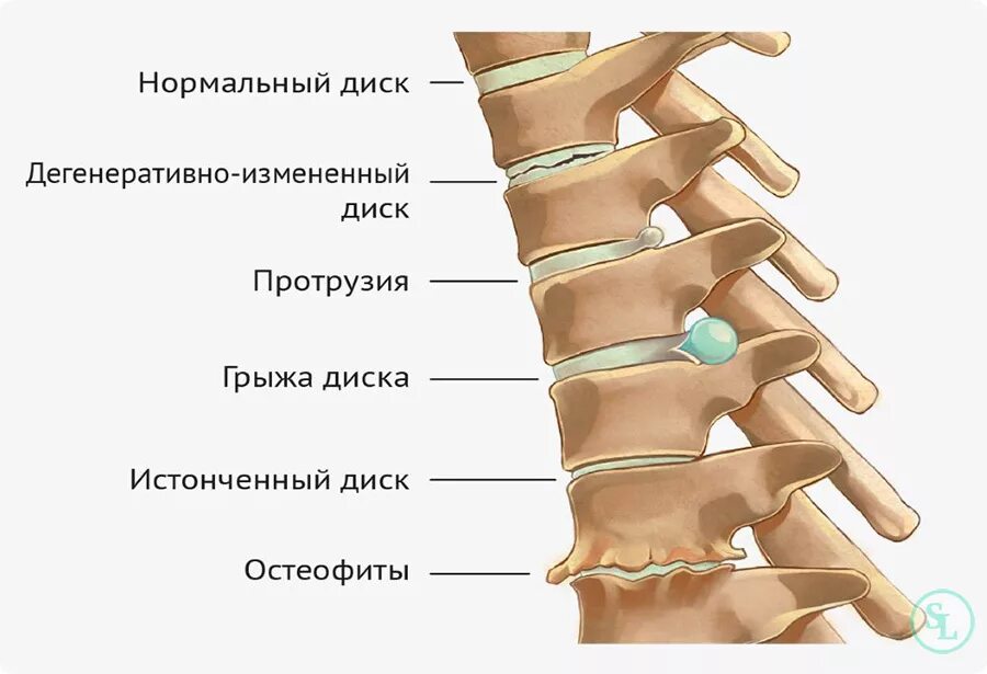 Протрузии межпозвонковых дисков фото Грыжа межпозвоночного диска, операция по удалению в Москве, стоимость и цены