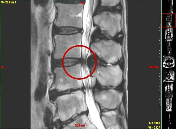 Протрузии поясничного отдела фото Протрузии дисков с5 6 7