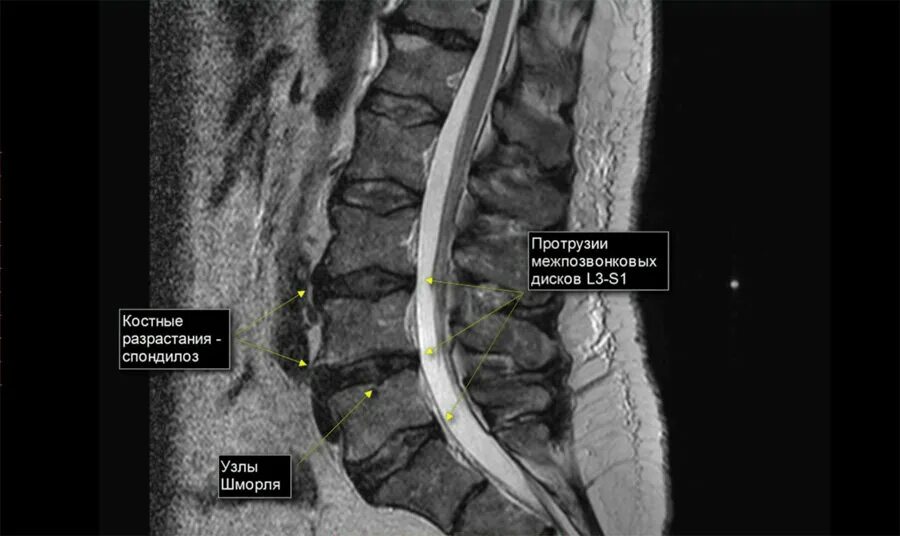 Протрузии поясничного отдела фото Протрузия поясничного отдела на МРТ MRT-V Дзен