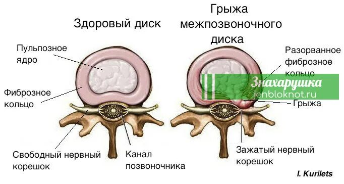 Протрузия дисков фото Дорзальная медианная грыжа l5 s1