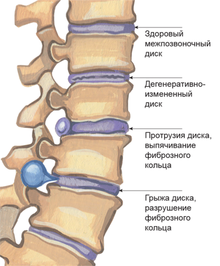 Протрузия дисков фото Грыжи межпозвоночных дисков - симптомы, виды межпозвоночных грыж, лечение и удал